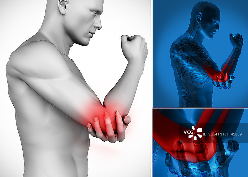 三张肘部疼痛图像图片素材