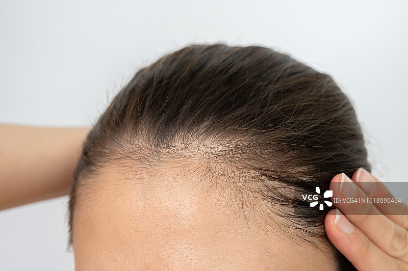 亚洲女性额头上的稀疏头发，女性型脱发可从发缝变宽发展为整体稀疏图片素材