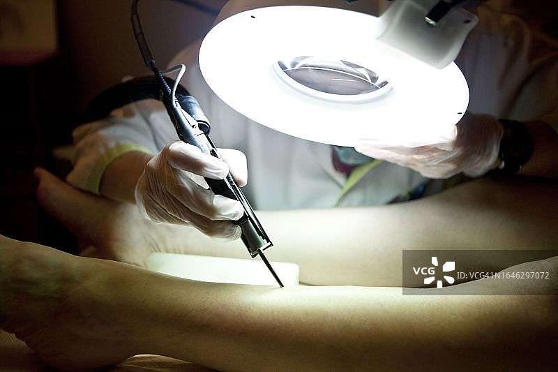 静脉曲张激光治疗图片素材