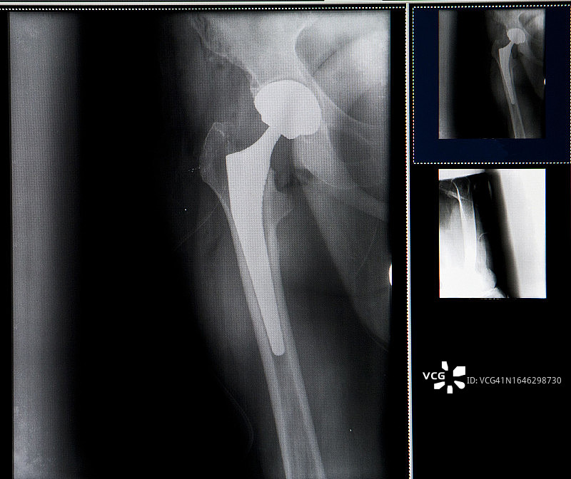 髋关节假体手术图片素材