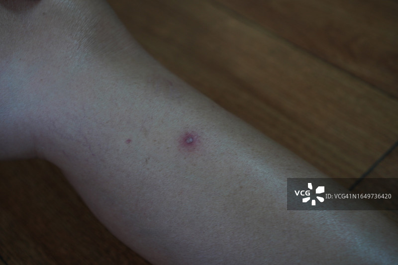 小腿上的水泡脓疱病/坏疽图片素材