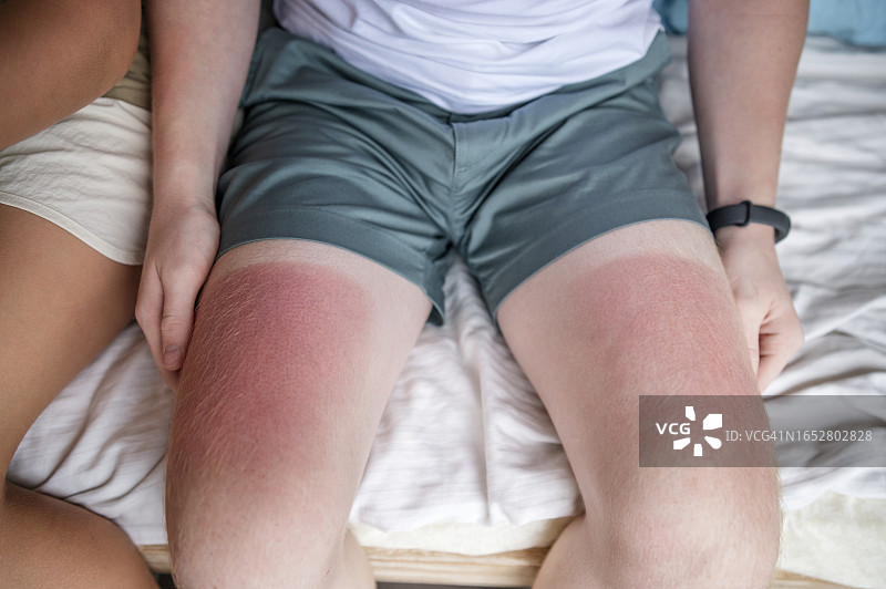 晒伤的少年腿部图片素材