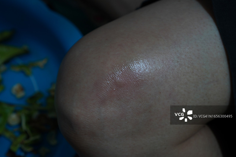 膝盖伤口图片素材