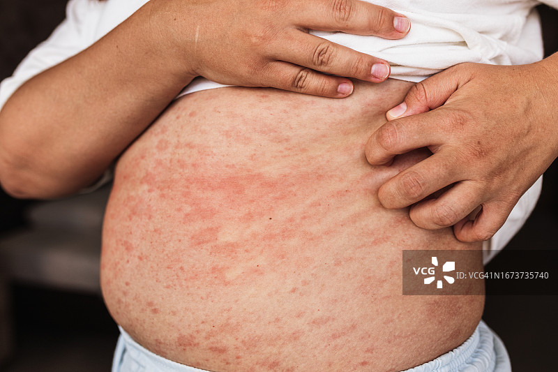 覆盖着红色荨麻疹和抓痕的丰满女人躯干特写照片图片素材