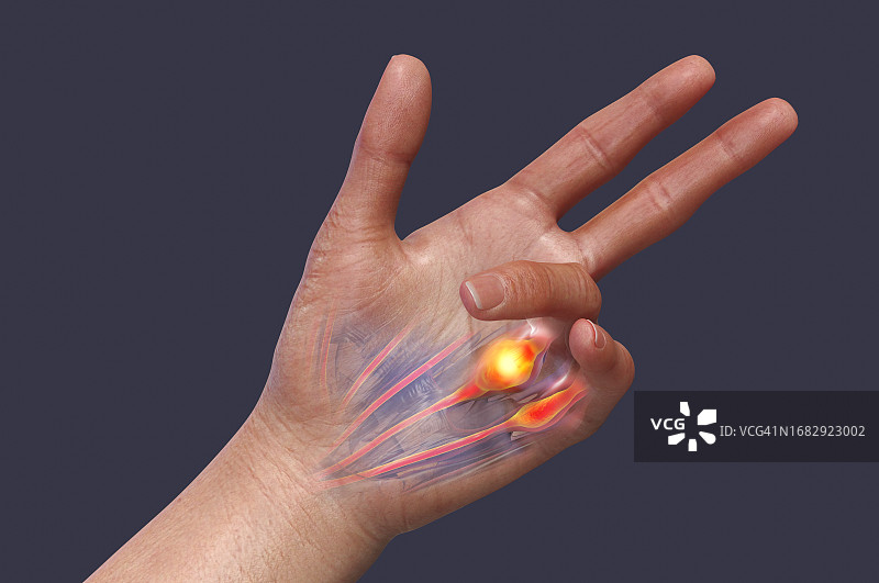 掌腱膜挛缩插图图片素材