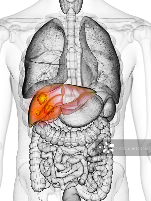 肝癌，图示图片素材