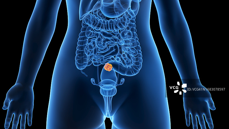 结肠癌，图示图片素材