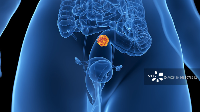 结肠癌，图示图片素材