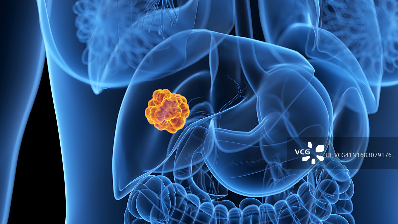 肝癌，图示图片素材
