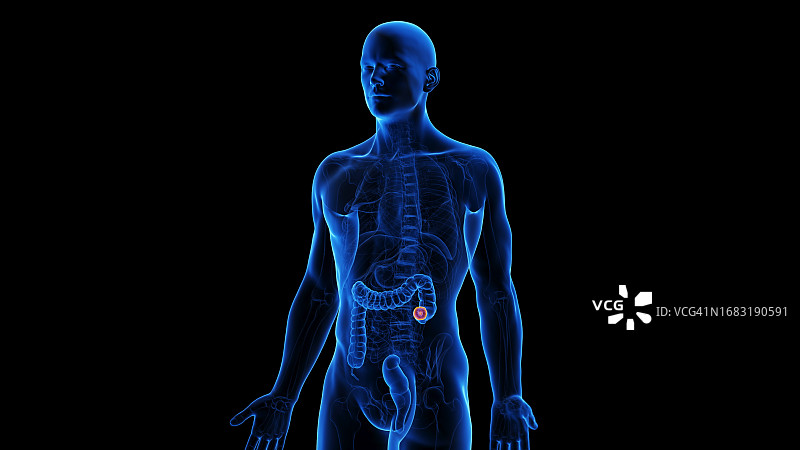 结肠切除术插图图片素材