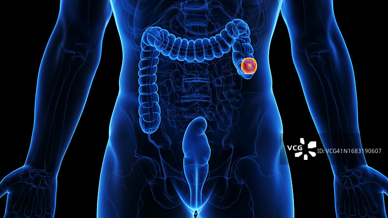结肠切除术插图图片素材