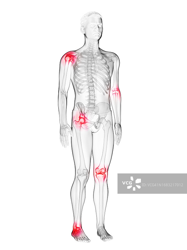 男人疼痛的关节插画图片素材