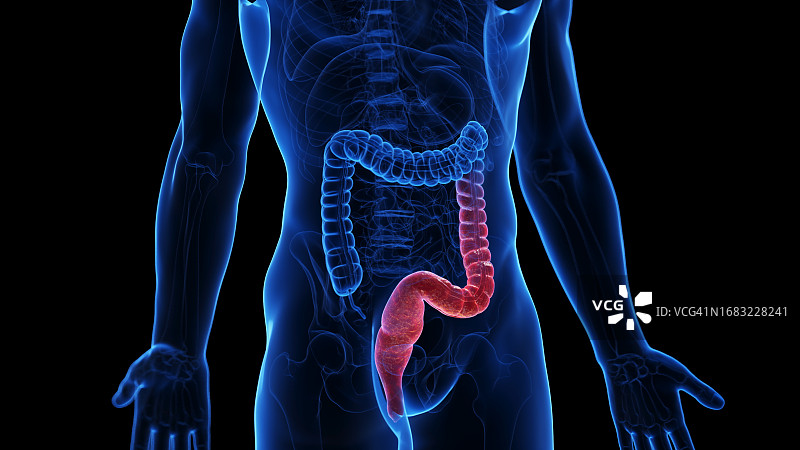 溃疡性结肠炎插图图片素材