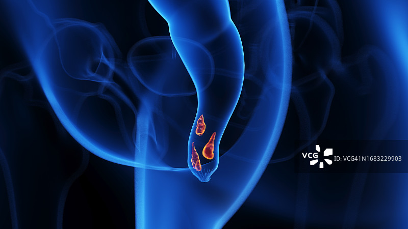 痔疮插图图片素材