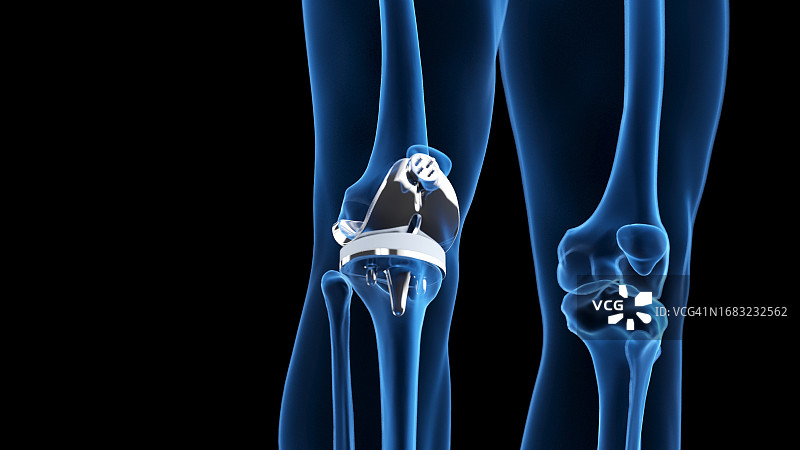 膝关节置换术插图图片素材