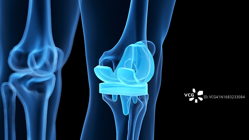 膝关节置换术插图图片素材