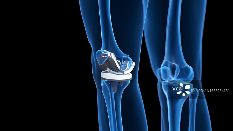 膝关节置换术插图图片素材