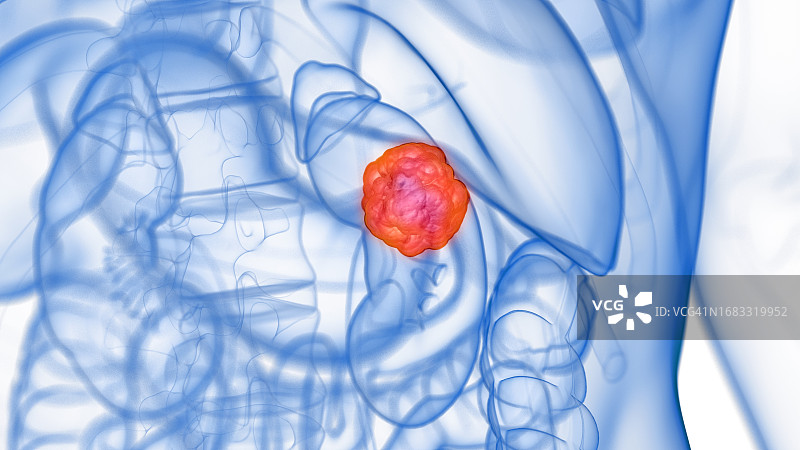 肾脏肿瘤插画图片素材