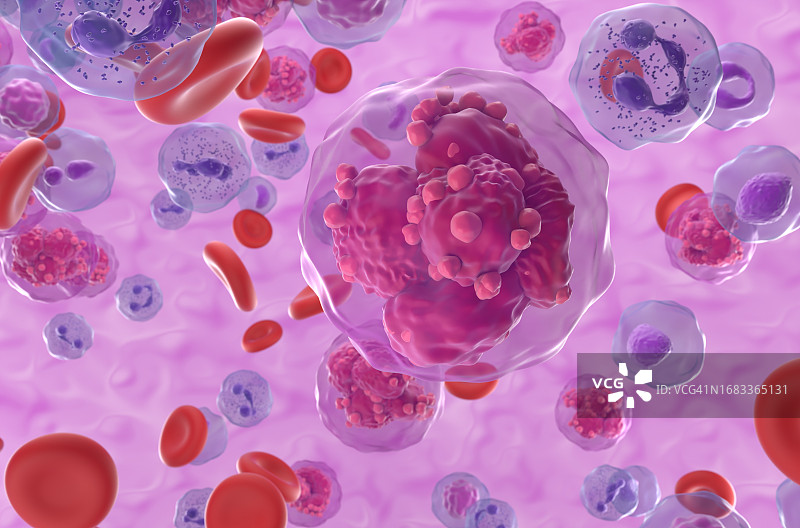 急性淋巴细胞白血病插图图片素材
