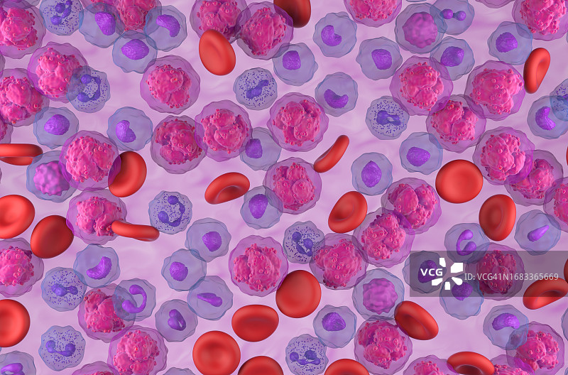 急性淋巴细胞白血病插图图片素材