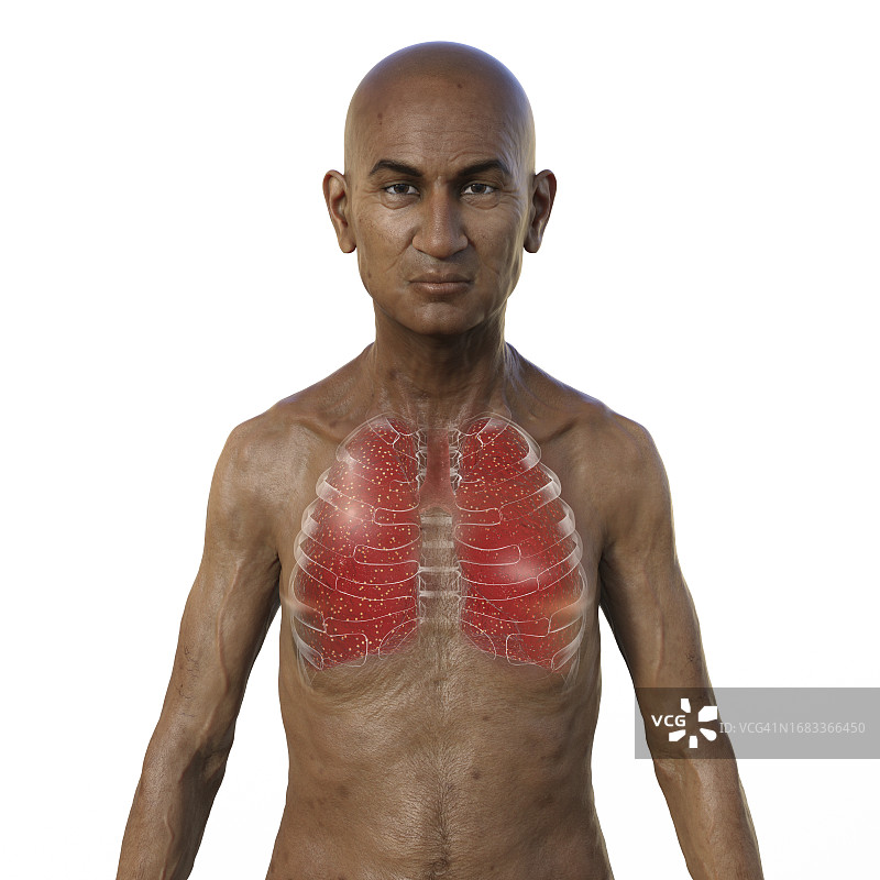 粟粒性肺结核患者插图图片素材