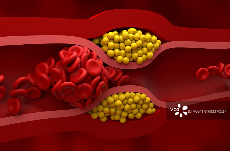 动脉阻塞插图图片素材