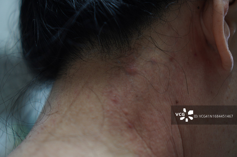 女人脖子上的红色皮疹图片素材