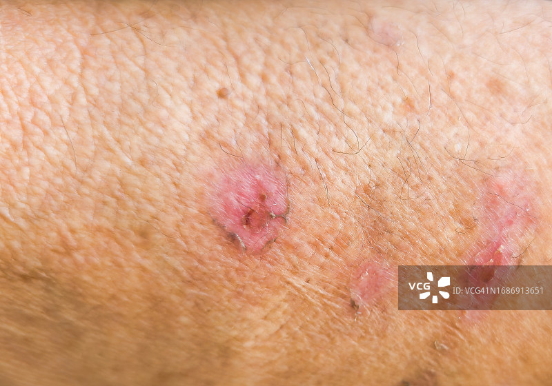 蒸汽灼伤图片素材