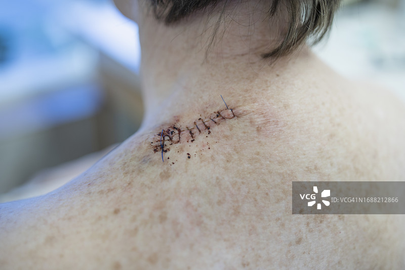 女性背部手术后的医用缝线图片素材