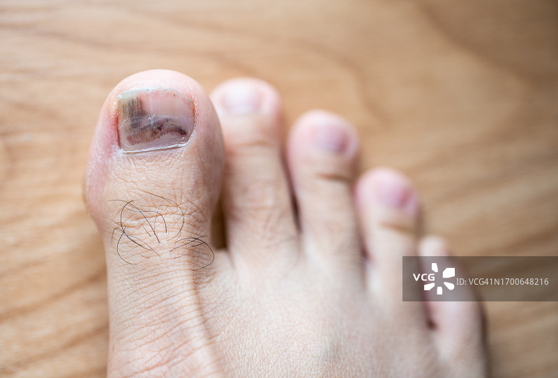 跑步者的脚趾，因压力、剪切和摩擦造成的损伤图片素材