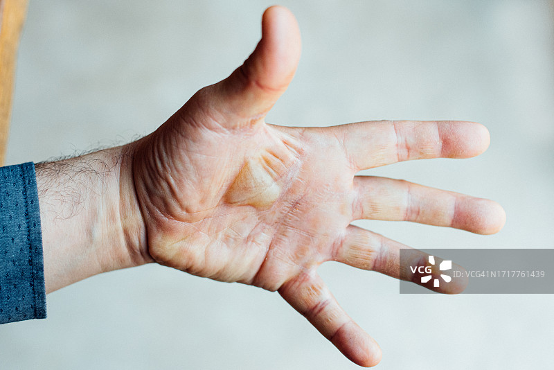 有水泡的烧伤手图片素材