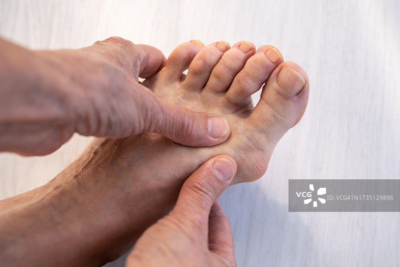 女人触摸并按摩拇趾外翻畸形的脚，骨头从拇指底部突出图片素材