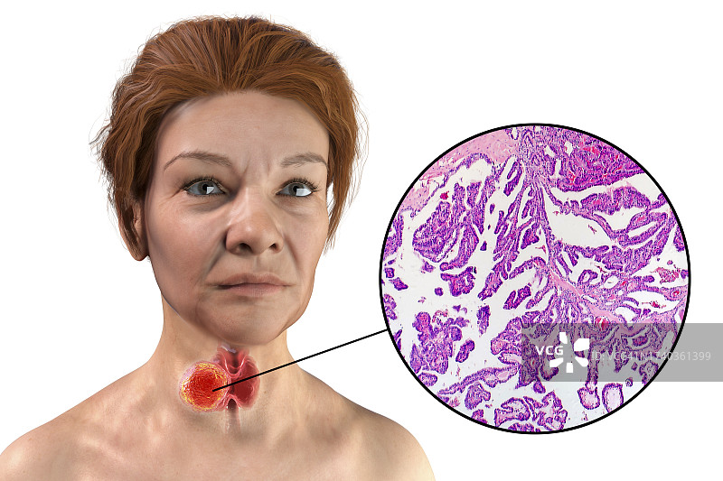 患有甲状腺癌的女人插图图片素材