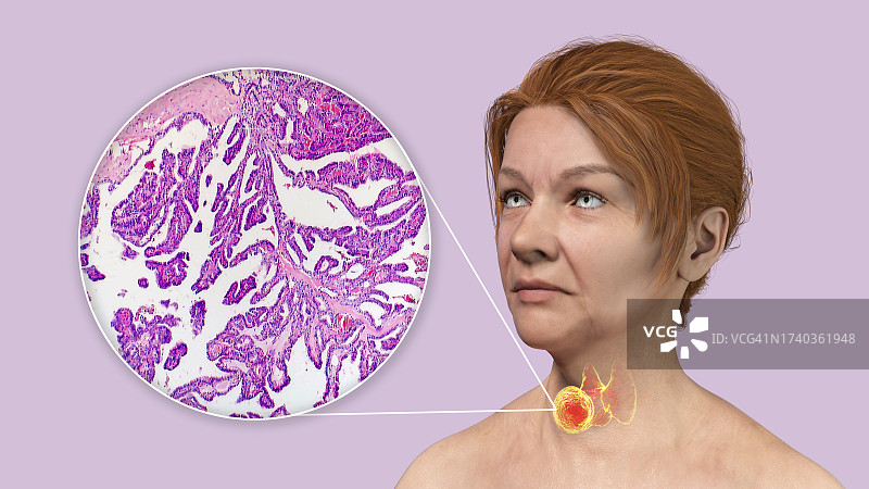 患有甲状腺癌的女人插图图片素材