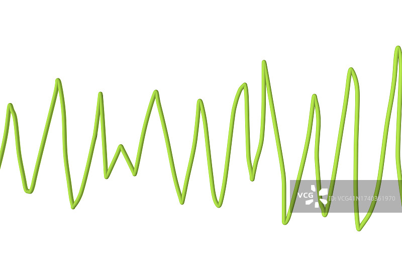 尖端扭转型室性心动过速心律图片素材