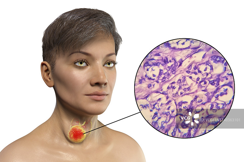 患有甲状腺癌的女人插图图片素材
