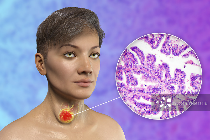 患有甲状腺癌的女人插图图片素材