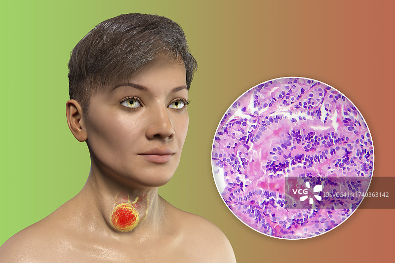 患有甲状腺癌的女人插图图片素材