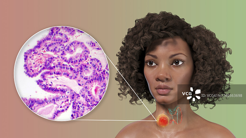 患有甲状腺癌的女人插图图片素材