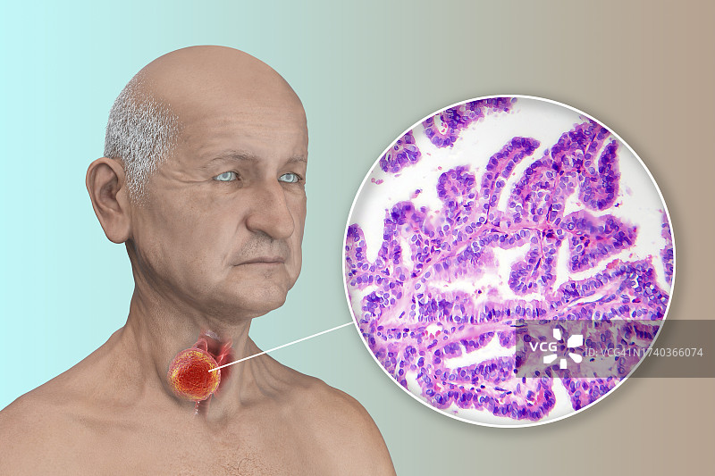 甲状腺癌患者插图图片素材