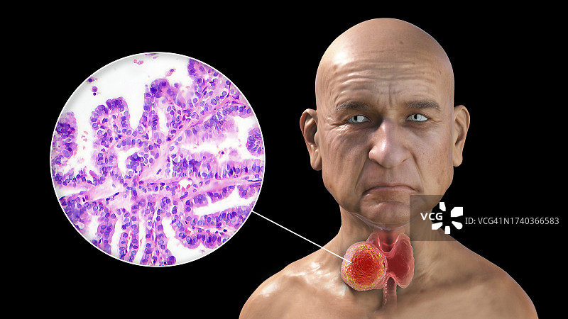 甲状腺癌患者插图图片素材