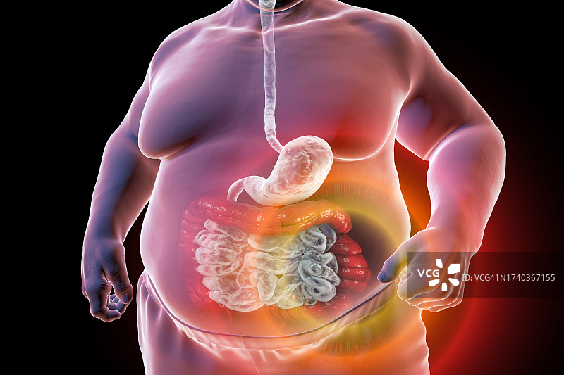 肠易激综合征插图图片素材