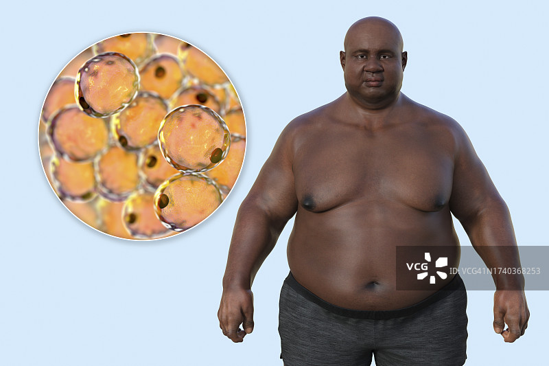 超重男子的脂肪细胞，插图图片素材