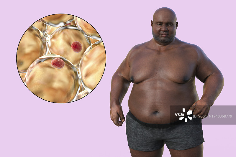 超重男子的脂肪细胞，插图图片素材