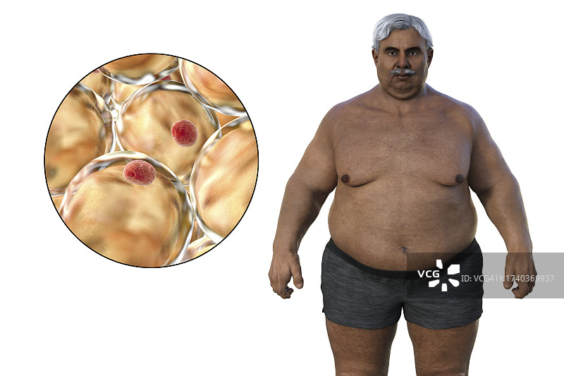 超重男子的脂肪细胞，插图图片素材