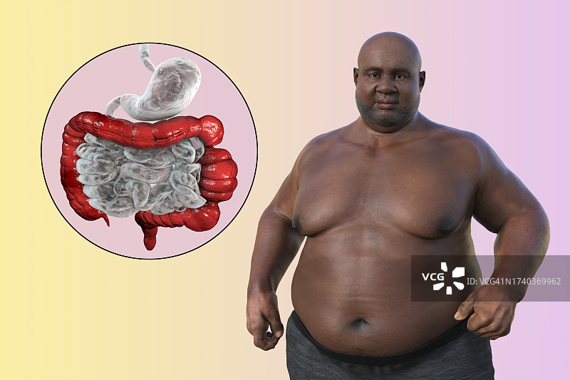 肠易激综合征插图图片素材