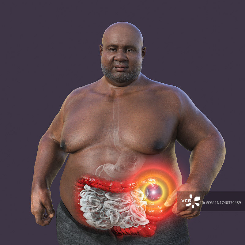 肠易激综合征插图图片素材