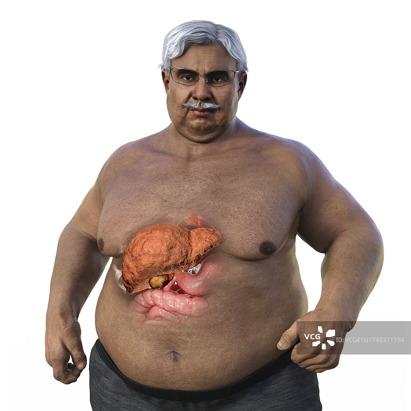 患有脂肪肝的超重男子插图图片素材