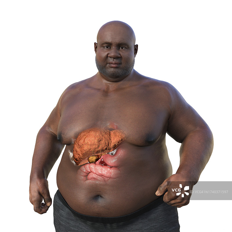 患有脂肪肝的超重男子插图图片素材