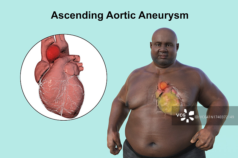 患有升主动脉瘤的肥胖男人，插图图片素材